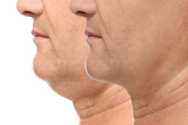 HIFU - Breakthrough in Anti - ageing 2 hifu results Leicester