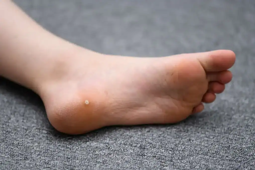 Cryotherapy For Warts And Also Verrucas 2 Image of verruca on the bottom of the foot that able to be treated with Cryotherapy Leicester