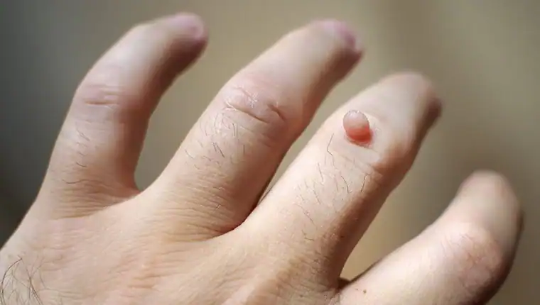 Cryotherapy For Warts And Also Verrucas 1 Image of blemish that Cryotherapy Leicester can remove with Lipo 360.