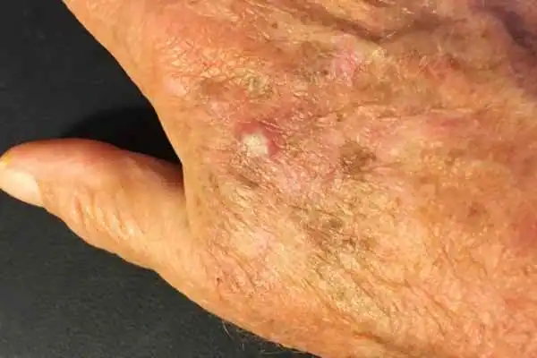 CryoPen for Actinic Keratoses 1 Image of Actinic keratoses Leicester on a person hand